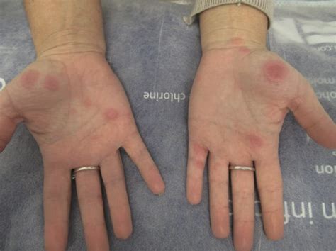 Recurrent rash and orogenital ulcers .